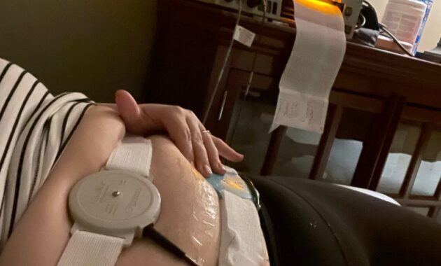 Nonstress Tests For High BMI in Pregnancy